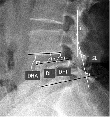 Comparisons of oblique lumbar interbody fusion and transforaminal lumbar interbody fusion for degenerative spondylolisthesis: a prospective cohort study with a 2-year follow-up